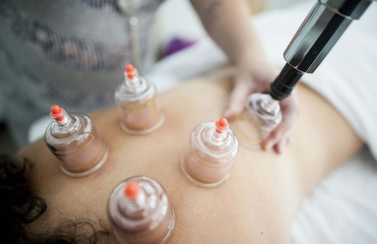 Terapia con ventosas sobre la espalda